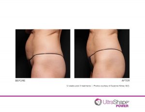 , UltraShape &#8211; Body Shaping